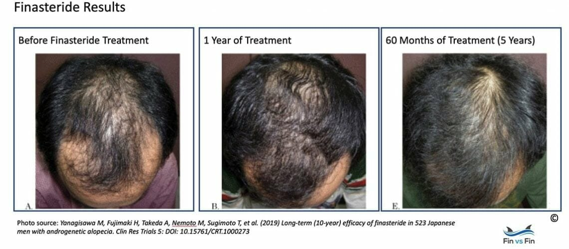 finasteryd-u-mezczyzn-5-lat.png
